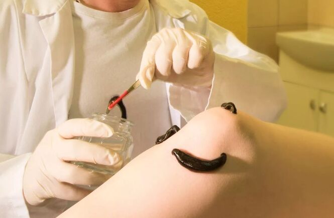 Hirudotherapie bei Krampfadern