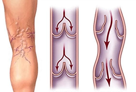 Normale Vena und Krampf